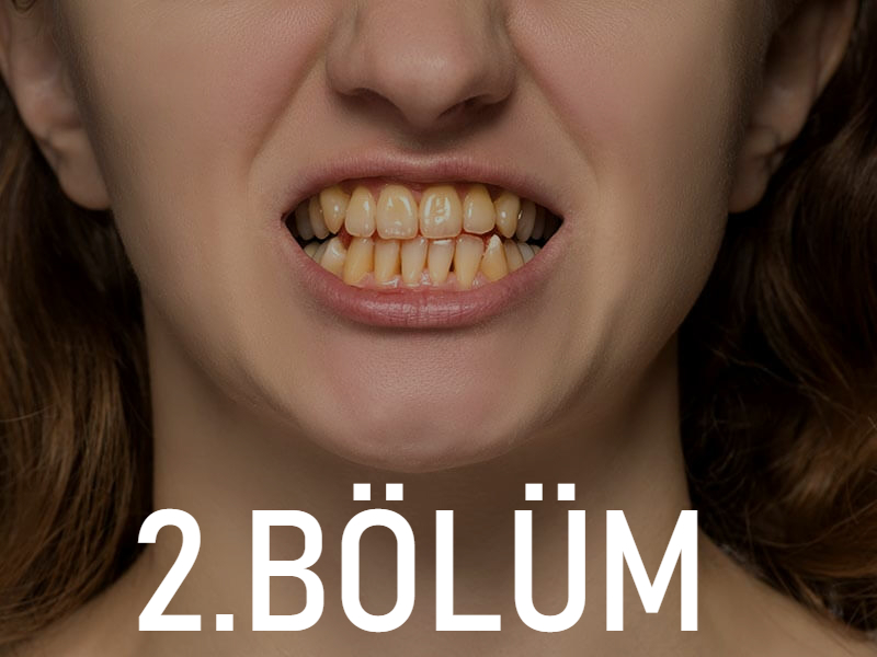 diş sararmasının nedenleri, dişlerimiz neden sararır, diş sararması, diş tedavisi, eskişehir diş hekimi